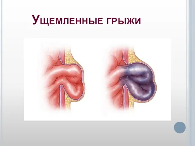 Ущемленные грыжи