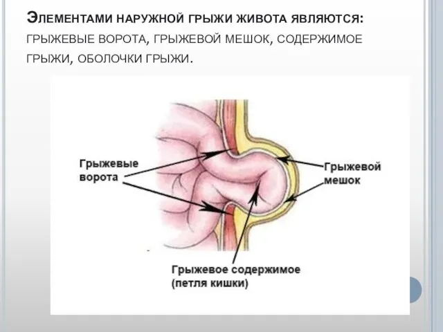 Элементами наружной грыжи живота являются: грыжевые ворота, грыжевой мешок, содержимое грыжи, оболочки грыжи.