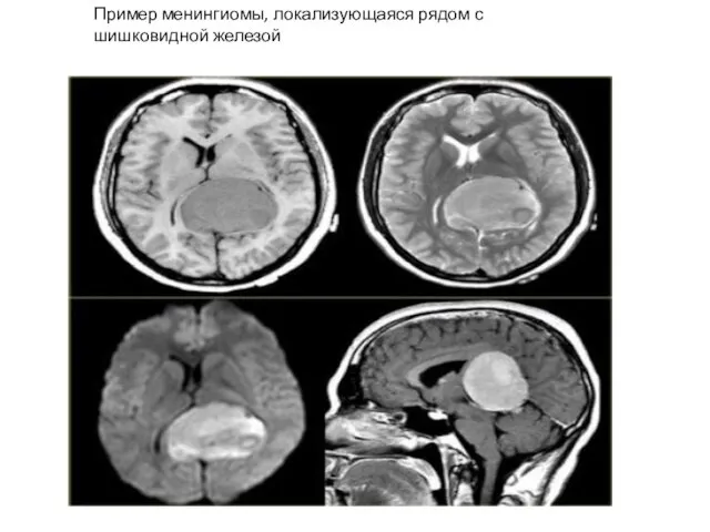 Пример менингиомы, локализующаяся рядом с шишковидной железой