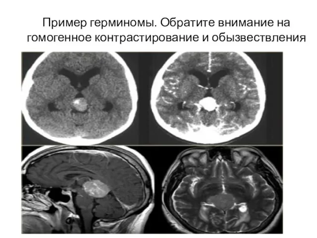 Пример герминомы. Обратите внимание на гомогенное контрастирование и обызвествления