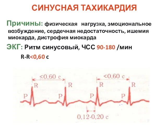 СИНУСНАЯ ТАХИКАРДИЯ Причины: физическая нагрузка, эмоциональное возбуждение, сердечная недостаточность, ишемия миокарда, дистрофия