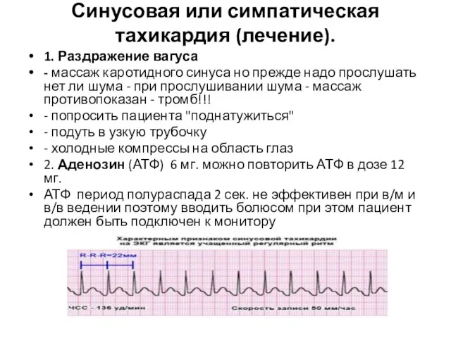 Синусовая или симпатическая тахикардия (лечение). 1. Раздражение вагуса - массаж каротидного синуса