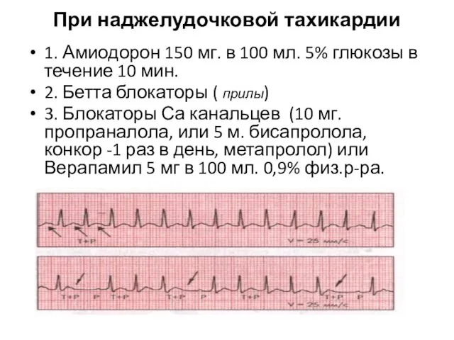 При наджелудочковой тахикардии 1. Амиодорон 150 мг. в 100 мл. 5% глюкозы