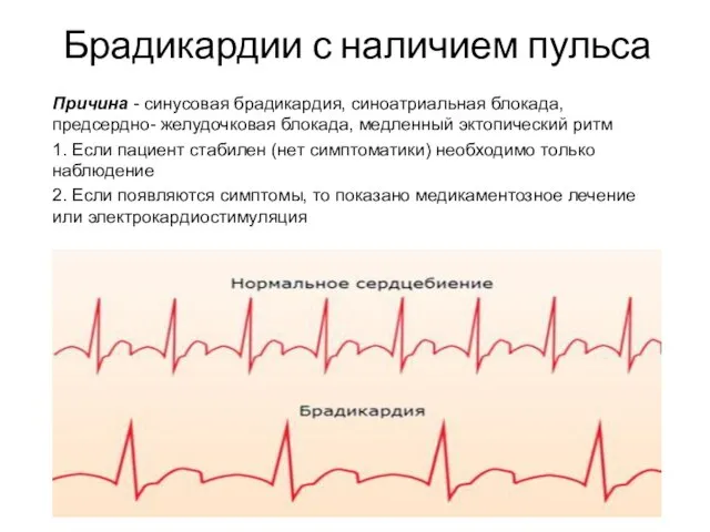 Брадикардии с наличием пульса Причина - синусовая брадикардия, синоатриальная блокада, предсердно- желудочковая