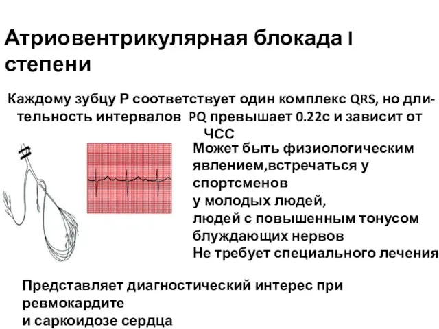 Атриовентрикулярная блокада I степени Каждому зубцу Р соответствует один комплекс QRS, но