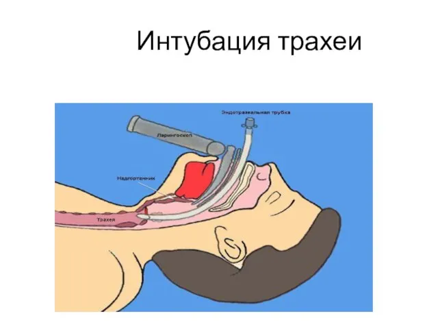 Интубация трахеи