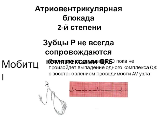 Атриовентрикулярная блокада 2-й степени Зубцы Р не всегда сопровождаются комплексами QRS Мобитц