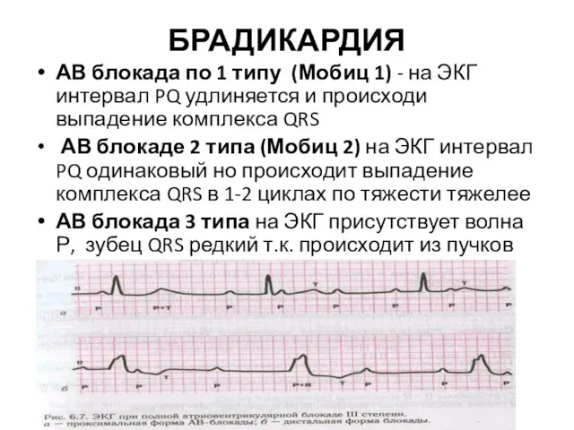 БРАДИКАРДИЯ АВ блокада по 1 типу (Мобиц 1) - на ЭКГ интервал