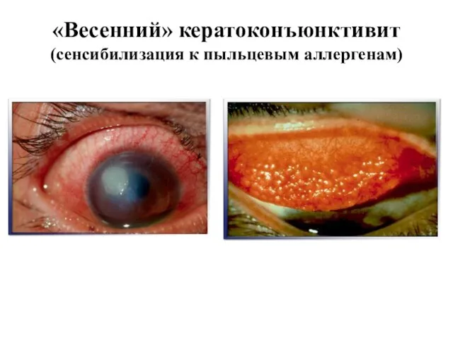«Весенний» кератоконъюнктивит (сенсибилизация к пыльцевым аллергенам)