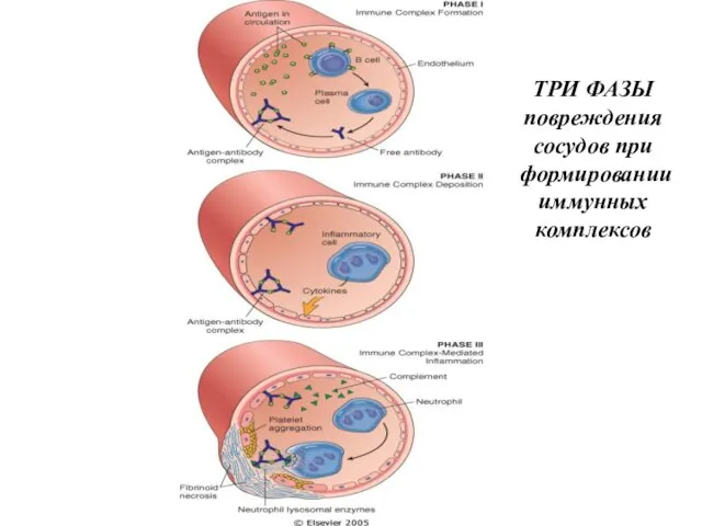 ТРИ ФАЗЫ повреждения сосудов при формировании иммунных комплексов