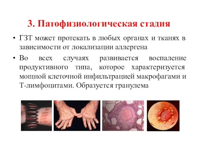 3. Патофизиологическая стадия ГЗТ может протекать в любых органах и тканях в