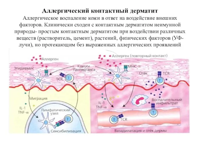 Аллергический контактный дерматит Аллергическое воспаление кожи в ответ на воздействие внешних факторов.