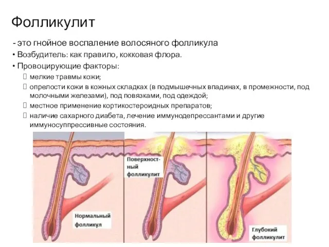 Фолликулит это гнойное воспаление волосяного фолликула Возбудитель: как правило, кокковая флора. Провоцирующие