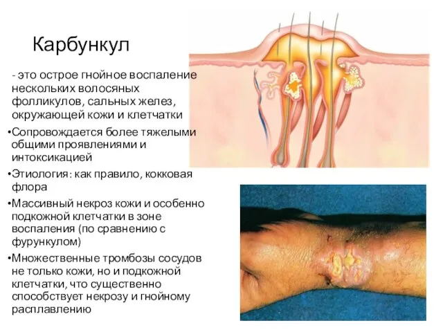 Карбункул - это острое гнойное воспаление нескольких волосяных фолликулов, сальных желез, окружающей