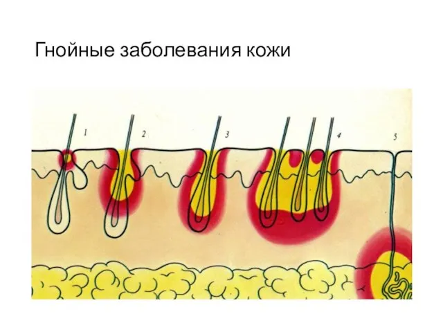 Гнойные заболевания кожи