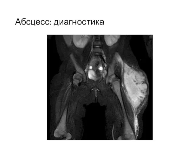 Абсцесс: диагностика