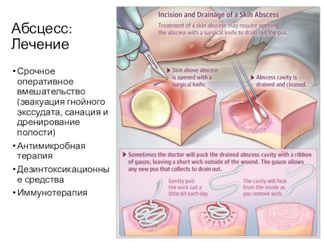 Абсцесс: Лечение Срочное оперативное вмешательство (эвакуация гнойного экссудата, санация и дренирование полости)