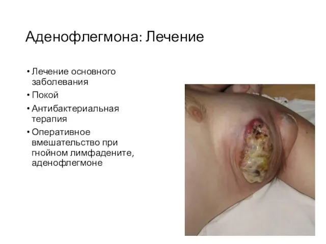 Аденофлегмона: Лечение Лечение основного заболевания Покой Антибактериальная терапия Оперативное вмешательство при гнойном лимфадените, аденофлегмоне