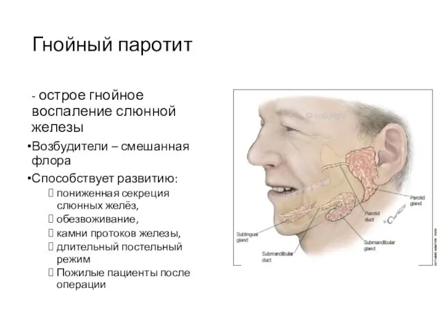 Гнойный паротит - острое гнойное воспаление слюнной железы Возбудители – смешанная флора