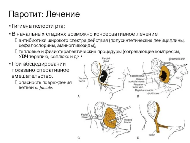 Паротит: Лечение Гигиена полости рта; В начальных стадиях возможно консервативное лечение антибиотики