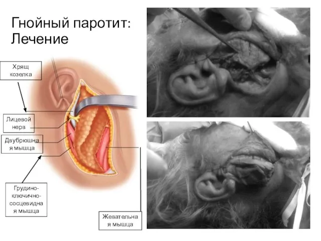 Гнойный паротит: Лечение Жевательная мышца Грудино-ключично-сосцевидная мышца Двубрюшная мышца Хрящ козелка Лицевой нерв