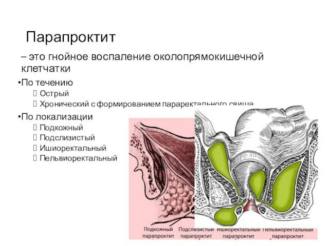 Парапроктит – это гнойное воспаление околопрямокишечной клетчатки По течению Острый Хронический с