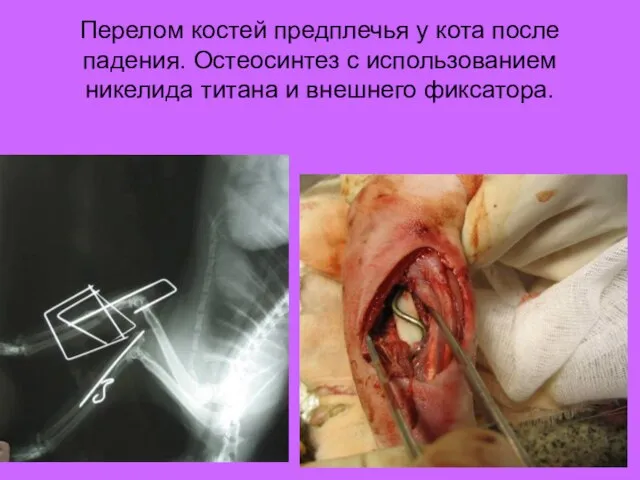 Перелом костей предплечья у кота после падения. Остеосинтез с использованием никелида титана и внешнего фиксатора.