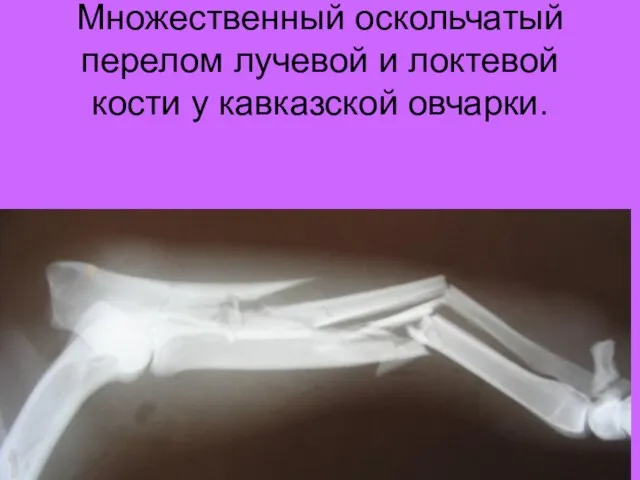 Множественный оскольчатый перелом лучевой и локтевой кости у кавказской овчарки.