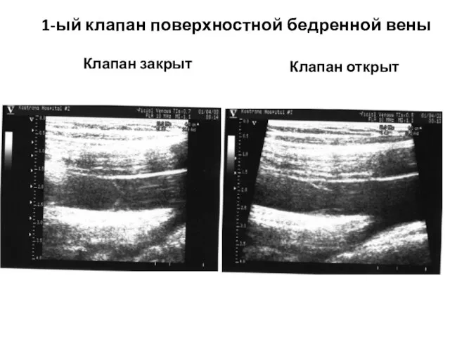 Клапан закрыт Клапан открыт 1-ый клапан поверхностной бедренной вены