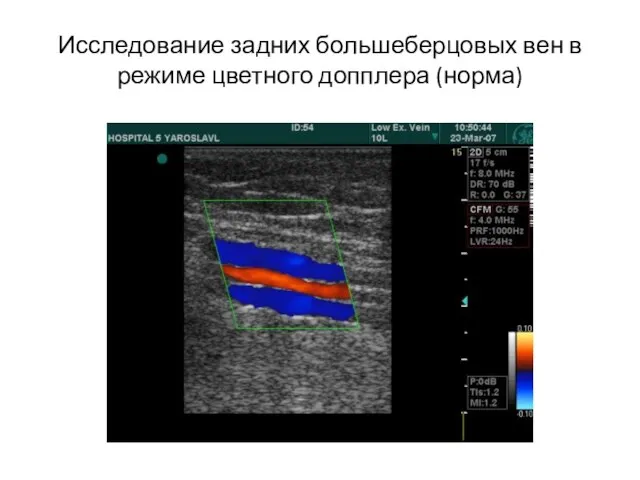 Исследование задних большеберцовых вен в режиме цветного допплера (норма)