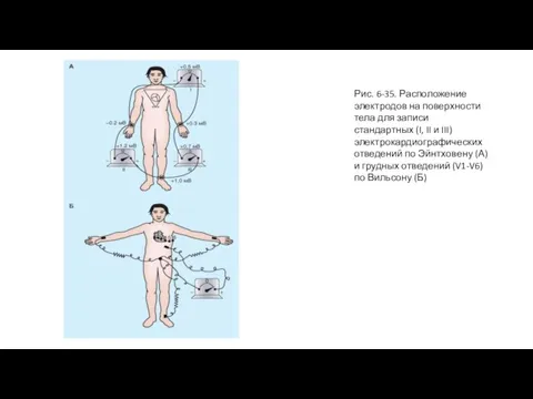 Рис. 6-35. Расположение электродов на поверхности тела для записи стандартных (I, II