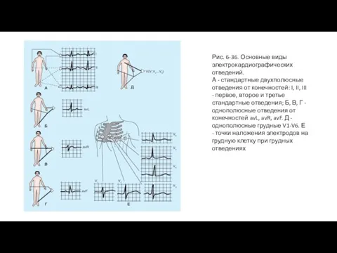 Рис. 6-36. Основные виды электрокардиографических отведений. А - стандартные двухполюсные отведения от