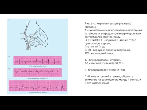 Рис. 6-41. Атриовентрикулярные (AV) блокады. А - схематическое представление положения катетеров-электродов при