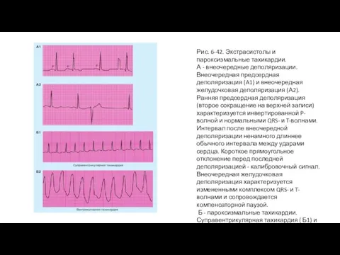 Рис. 6-42. Экстрасистолы и пароксизмальные тахикардии. А - внеочередные деполяризации. Внеочередная предсердная