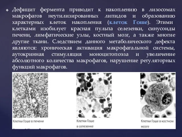 Дефицит фермента приводит к накоплению в лизосомах макрофагов неутилизированных липидов и образованию