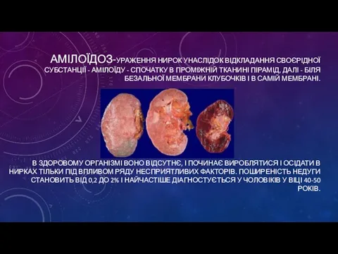 АМІЛОЇДОЗ-УРАЖЕННЯ НИРОК УНАСЛІДОК ВІДКЛАДАННЯ СВОЄРІДНОЇ СУБСТАНЦІЇ - АМІЛОЇДУ - СПОЧАТКУ В ПРОМІЖНІЙ