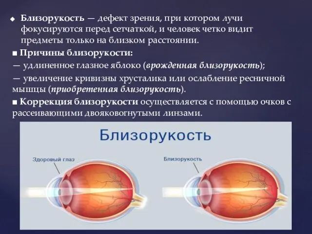 Близорукость — дефект зрения, при котором лучи фокусируются перед сетчаткой, и человек