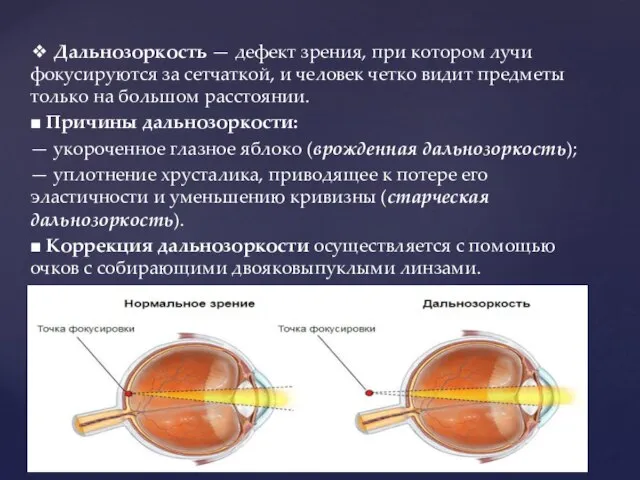 ❖ Дальнозоркость — дефект зрения, при котором лучи фокусируются за сетчаткой, и