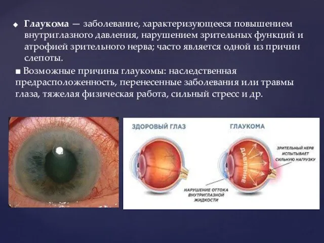 Глаукома — заболевание, характеризующееся повышением внутриглазного давления, нарушением зрительных функций и атрофией