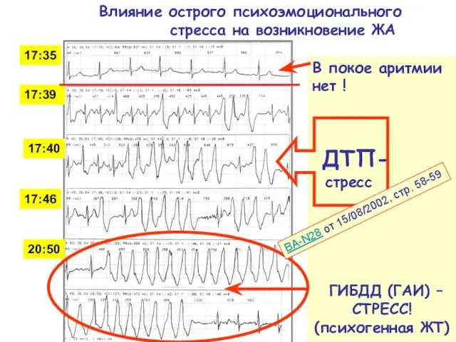 17:35 17:39 17:40 17:46 20:50 В покое аритмии нет ! ДТП- стресс