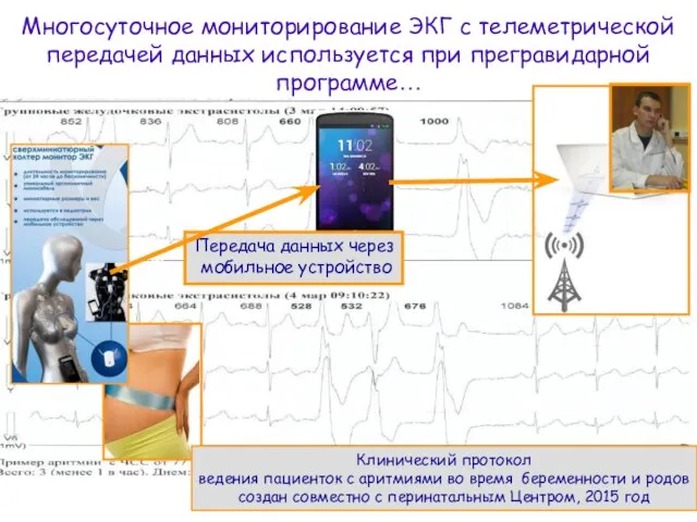 Многосуточное мониторирование ЭКГ с телеметрической передачей данных используется при прегравидарной программе… 6,5