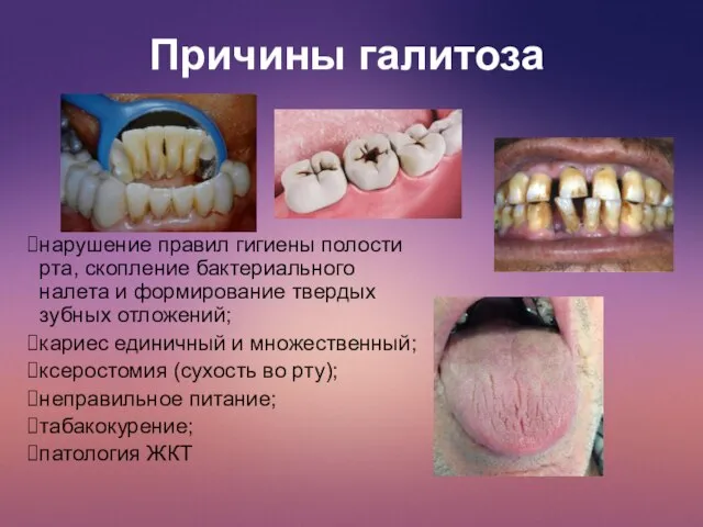 Причины галитоза нарушение правил гигиены полости рта, скопление бактериального налета и формирование
