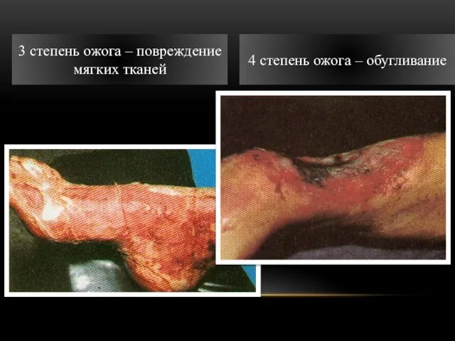 3 степень ожога – повреждение мягких тканей 4 степень ожога – обугливание