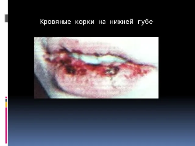 Кровяные корки на нижней губе