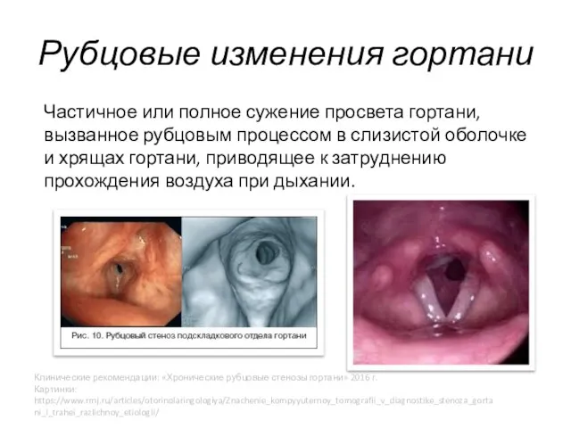 Рубцовые изменения гортани Частичное или полное сужение просвета гортани, вызванное рубцовым процессом