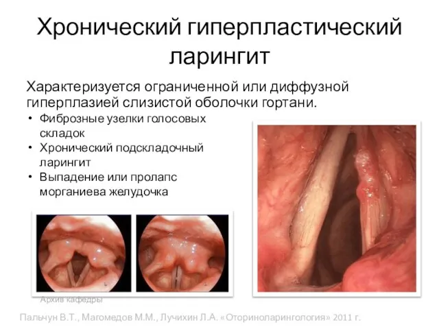 Хронический гиперпластический ларингит Характеризуется ограниченной или диффузной гиперплазией слизистой оболочки гортани. Фиброзные