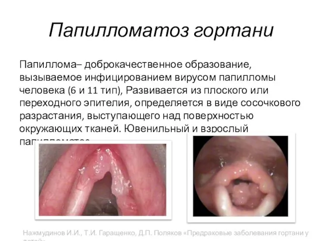 Папилломатоз гортани Папиллома– доброкачественное образование, вызываемое инфицированием вирусом папилломы человека (6 и