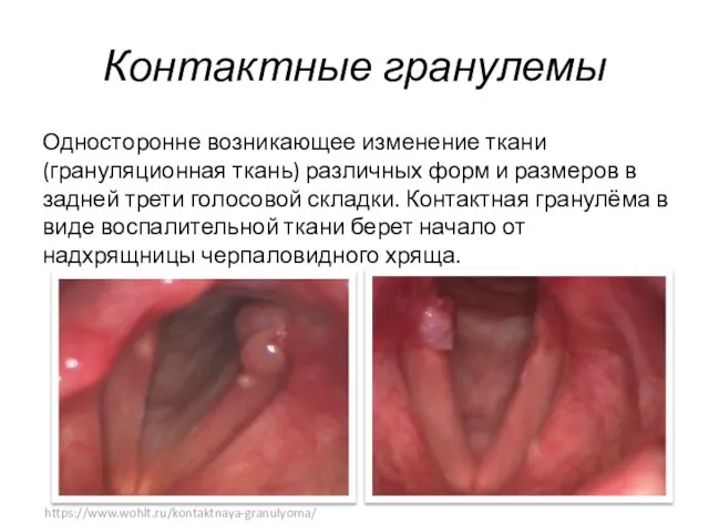 Контактные гранулемы Односторонне возникающее изменение ткани (грануляционная ткань) различных форм и размеров