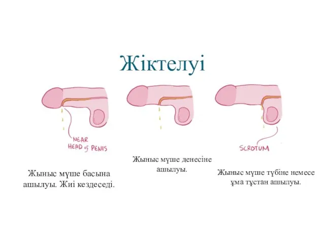 Жіктелуі Жыныс мүше басына ашылуы. Жиі кездеседі. Жыныс мүше денесіне ашылуы. Жыныс