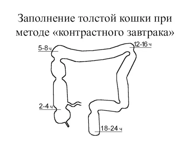 Заполнение толстой кошки при методе «контрастного завтрака»